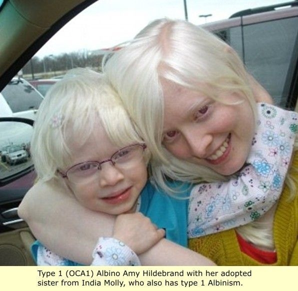 Albinisme de type OCA1 chez les blancs : peau blanche, les cheveux sont translucides La peau blanche est le 1er signe caractéristique d'albinisme dans les races
