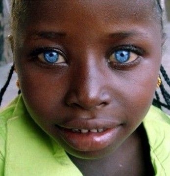      Albinisme partiel chez les noirs: yeux bleus