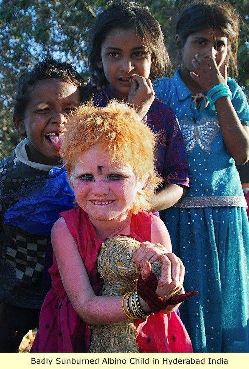 Enfant albinos sérieusement brûlée par le soleil (sud de l'Inde)