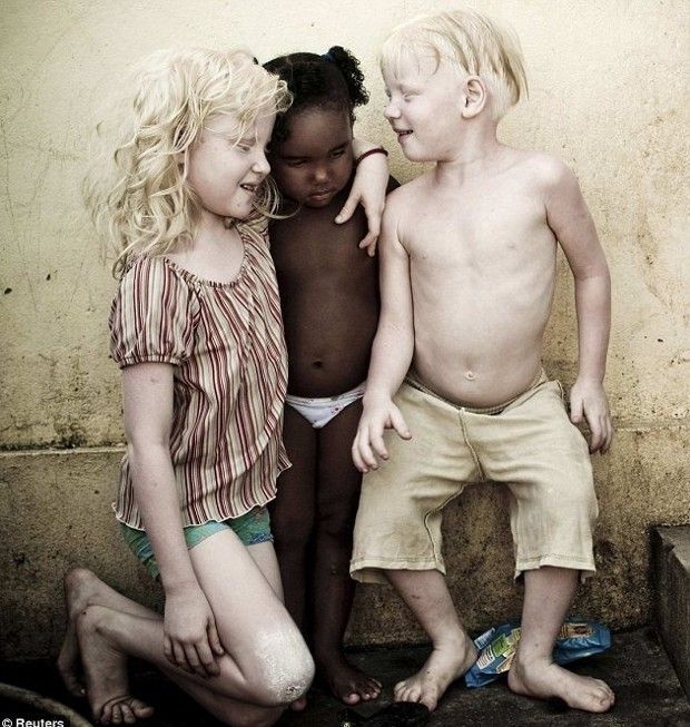                                     Enfants albinos