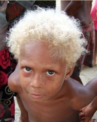  Albinisme partiel chez les noirs: cheveux blonds