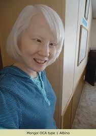 Albinisme de type OCA1 chez les jaunes : :peau blanche,les cheveux sont translucides